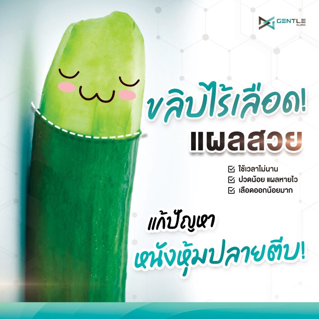 ขลิบไร้เลือด-ขลิบหนังหุ้มปลายอวัยวะเพศ