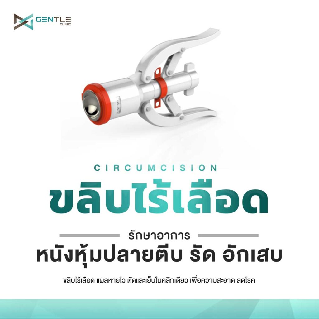 ขลิบไร้เลือด-ขลิบหนังหุ้มปลายอวัยวะเพศ